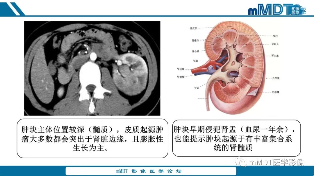 【PPT】肾髓质癌1例CT影像