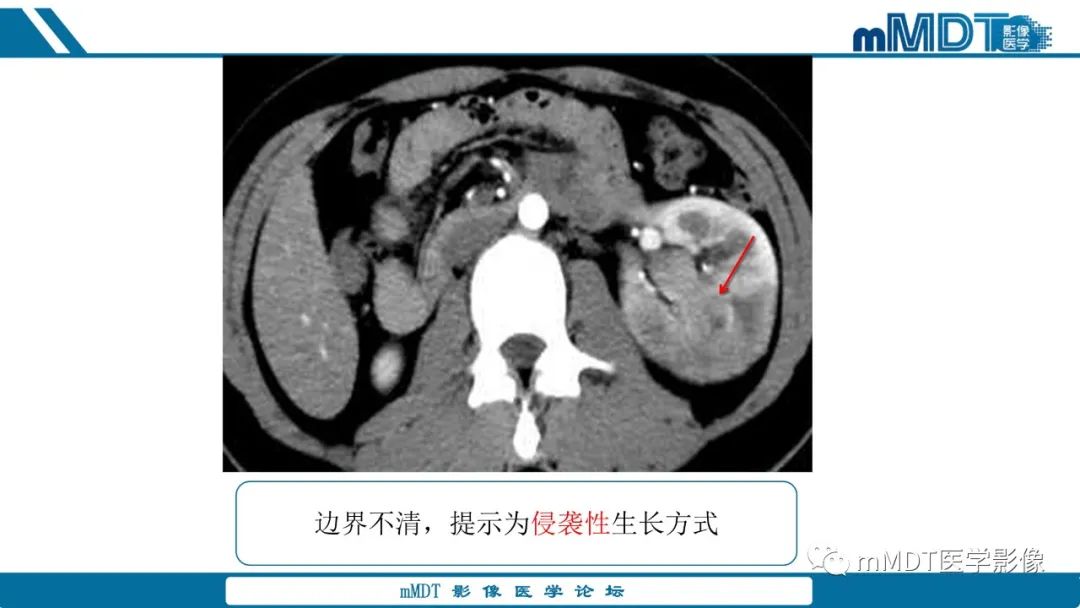 【PPT】肾髓质癌1例CT影像