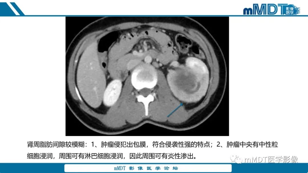 【PPT】肾髓质癌1例CT影像