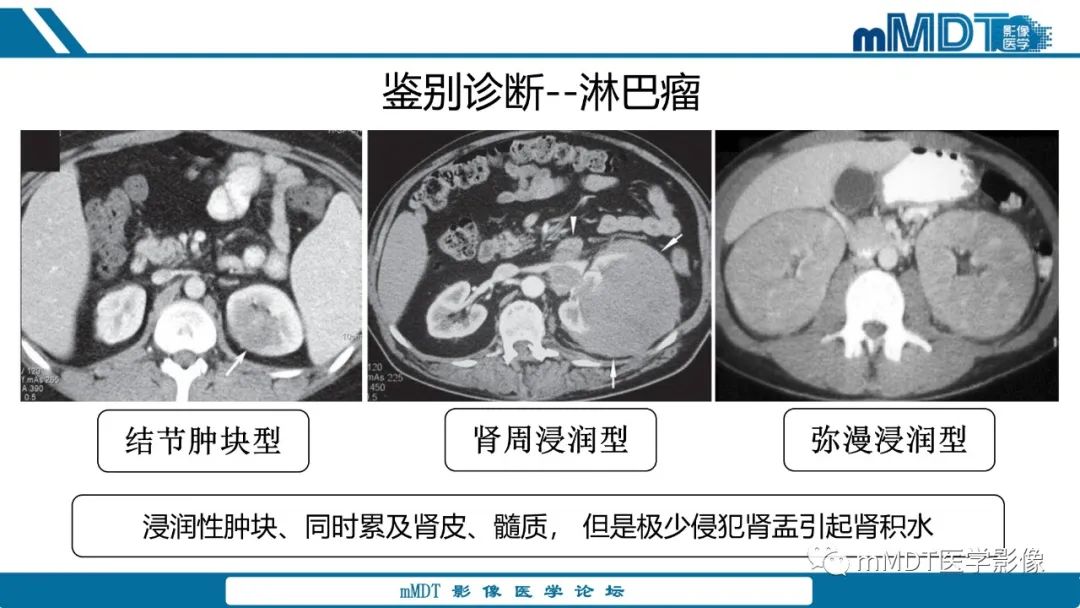 【PPT】肾髓质癌1例CT影像
