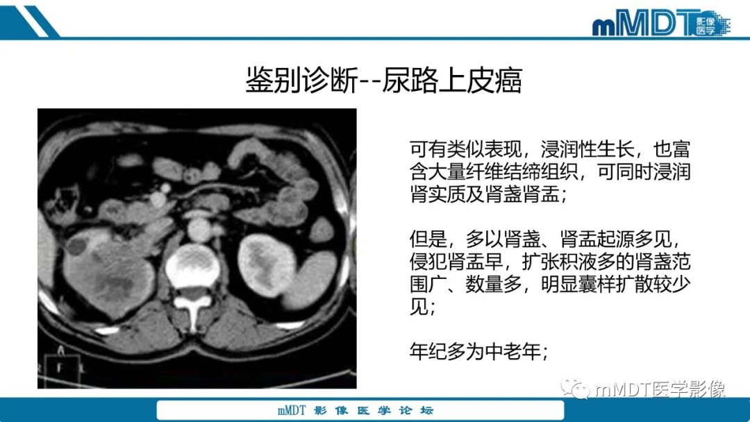 【PPT】肾髓质癌1例CT影像