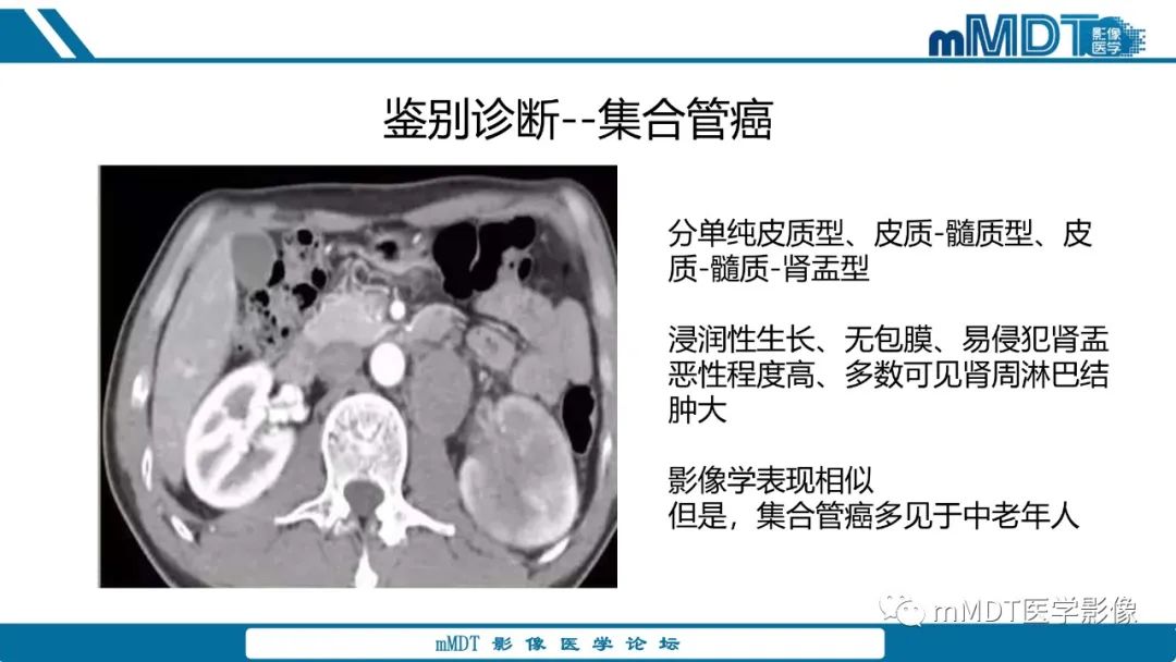 【PPT】肾髓质癌1例CT影像
