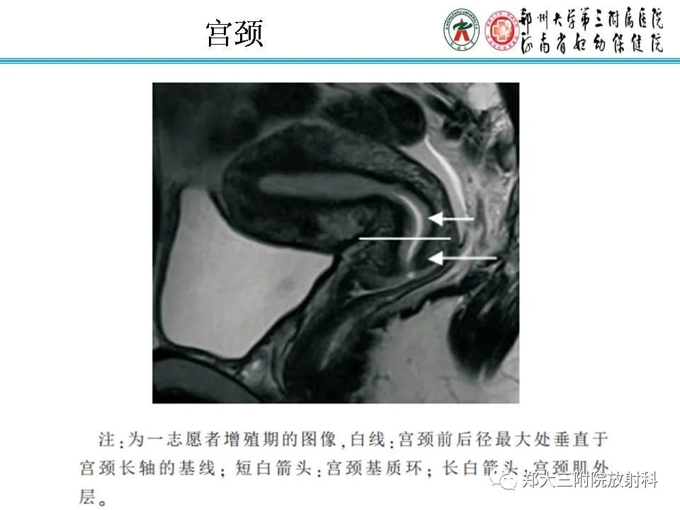 【PPT】育龄期女性正常子宫的MRI表现