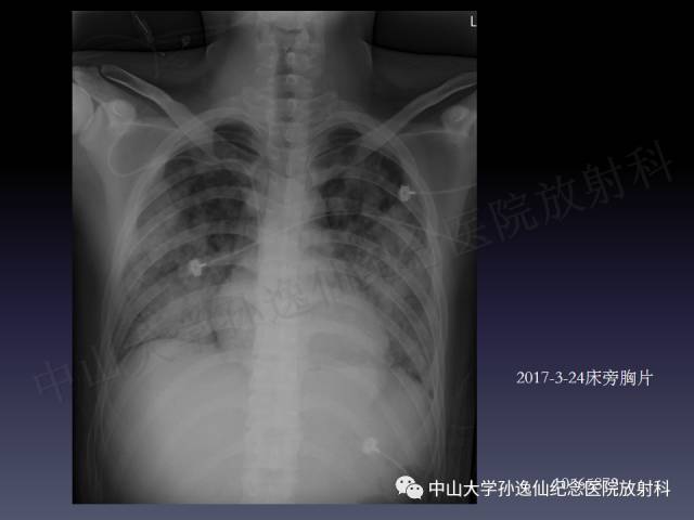【PPT】肺出血的影像学特征