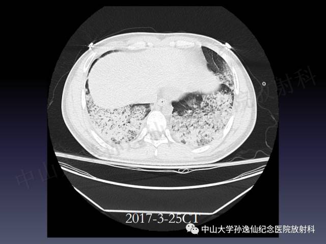 【PPT】肺出血的影像学特征