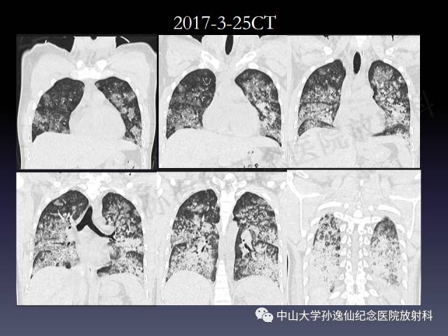 【PPT】肺出血的影像学特征