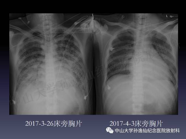 【PPT】肺出血的影像学特征