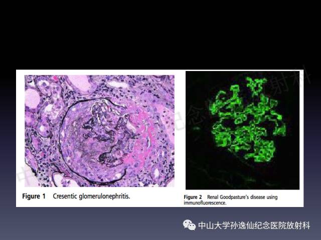 【PPT】肺出血的影像学特征