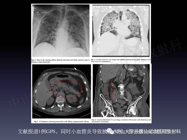 【PPT】肺出血的影像学特征