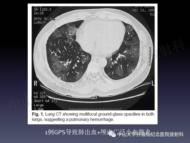 【PPT】肺出血的影像学特征