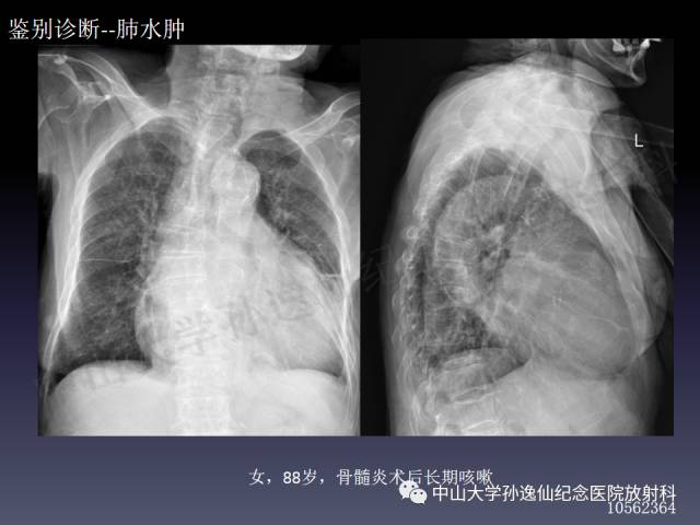 【PPT】肺出血的影像学特征