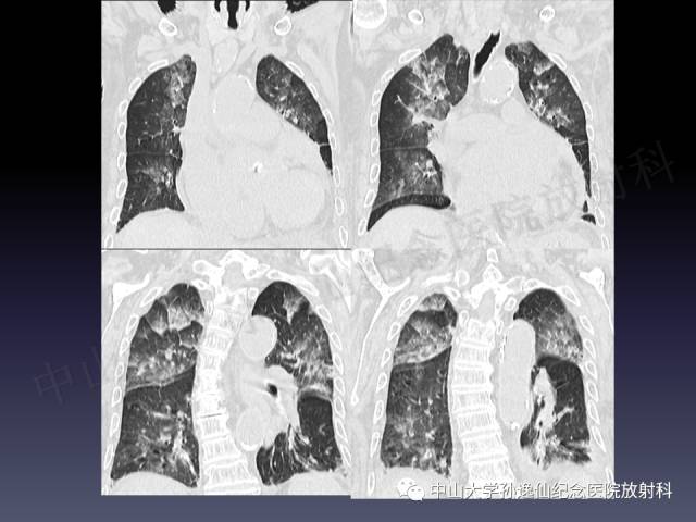 【PPT】肺出血的影像学特征