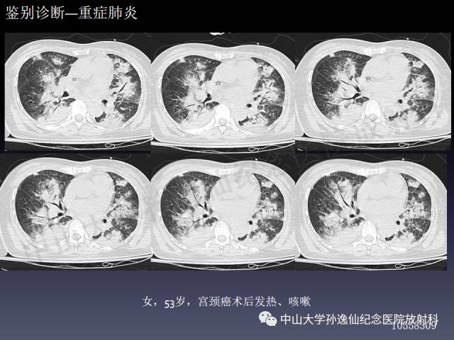 【PPT】肺出血的影像学特征