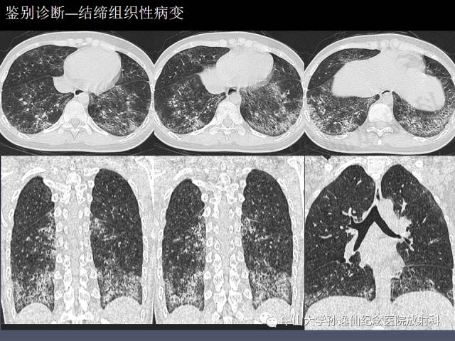 【PPT】肺出血的影像学特征