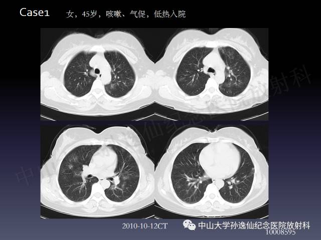 【PPT】肺出血的影像学特征