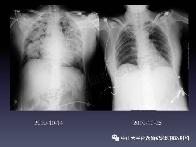 【PPT】肺出血的影像学特征