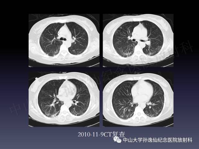 【PPT】肺出血的影像学特征