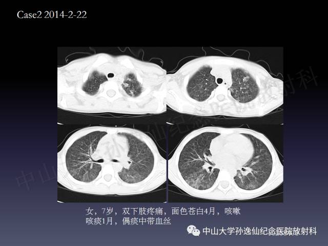 【PPT】肺出血的影像学特征