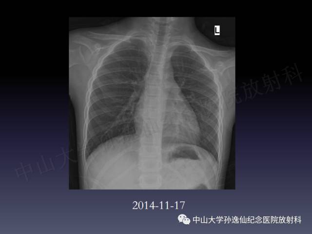 【PPT】肺出血的影像学特征