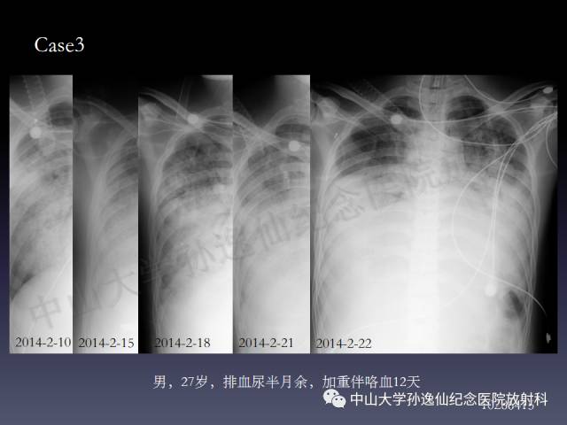 【PPT】肺出血的影像学特征