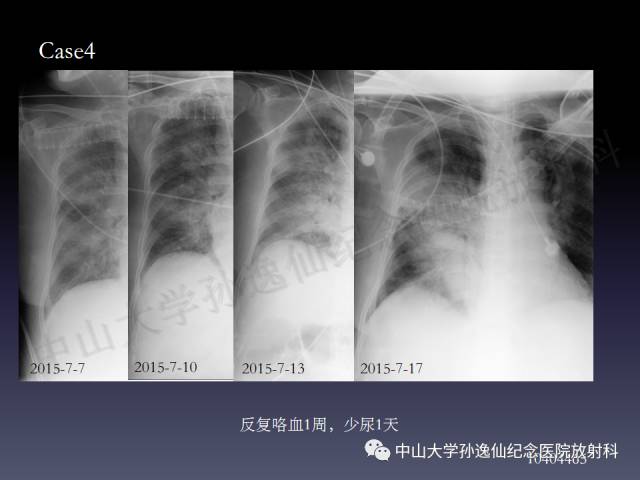 【PPT】肺出血的影像学特征