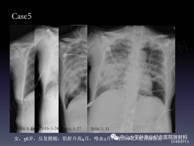 【PPT】肺出血的影像学特征