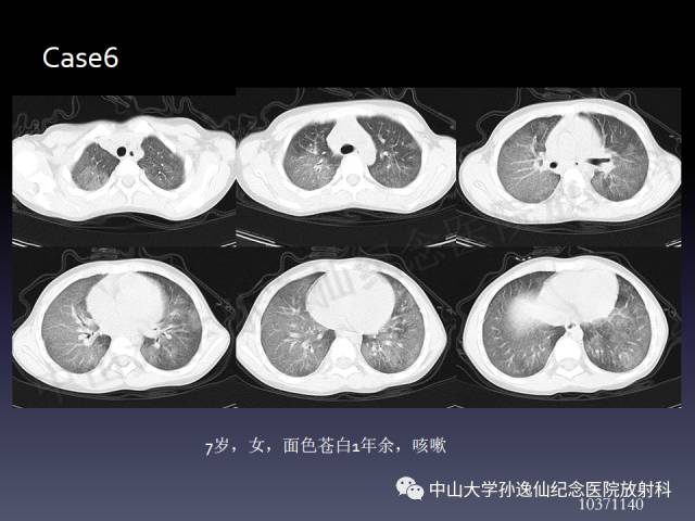 【PPT】肺出血的影像学特征