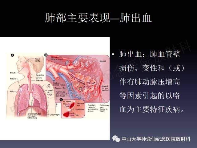 【PPT】肺出血的影像学特征