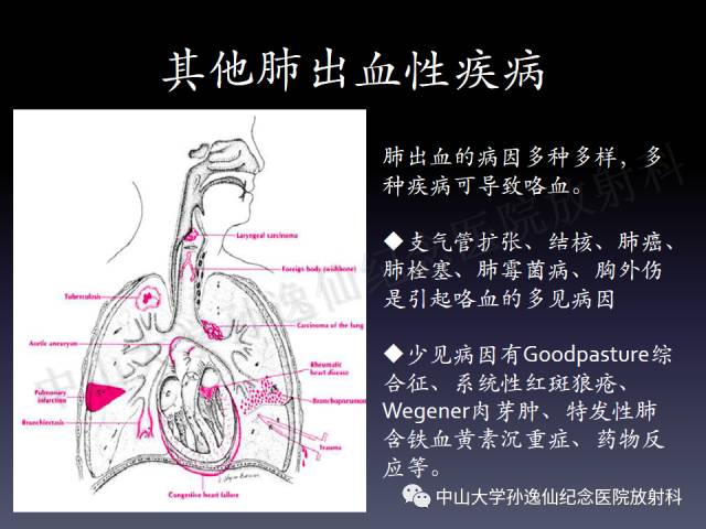 【PPT】肺出血的影像学特征