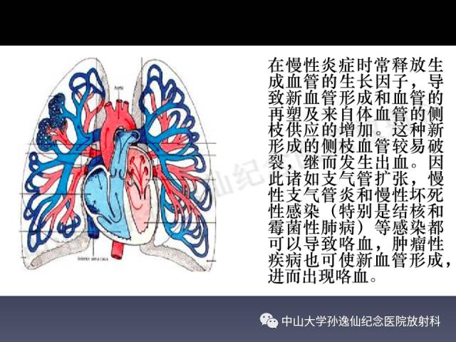 【PPT】肺出血的影像学特征