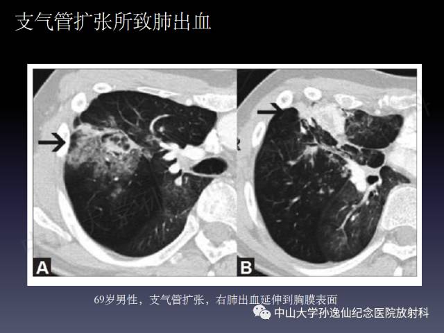 【PPT】肺出血的影像学特征