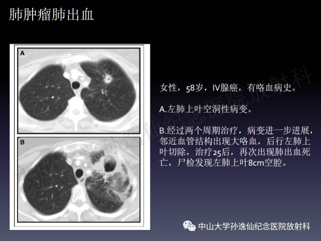【PPT】肺出血的影像学特征