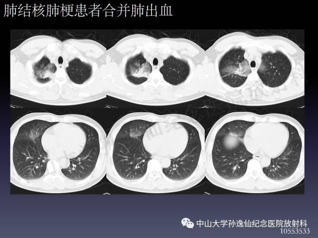 【PPT】肺出血的影像学特征