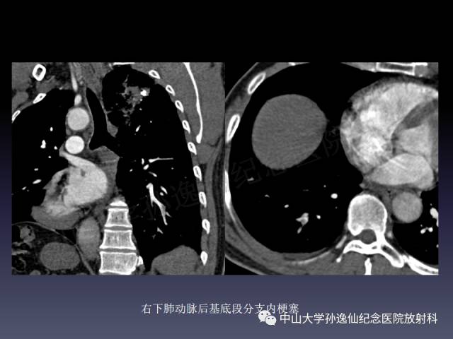 【PPT】肺出血的影像学特征