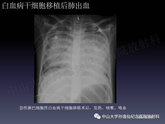 【PPT】肺出血的影像学特征