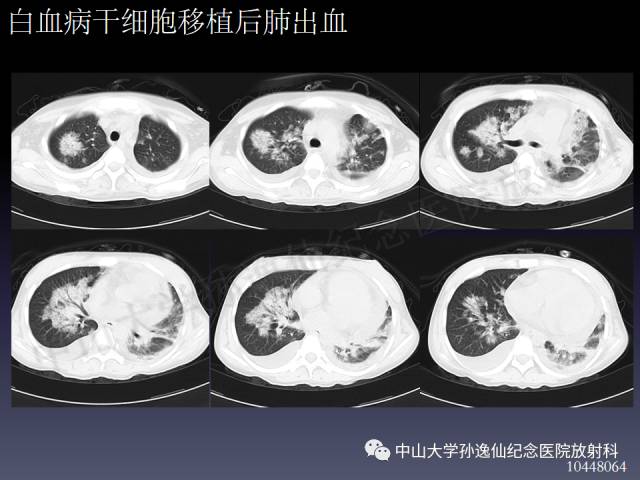 【PPT】肺出血的影像学特征