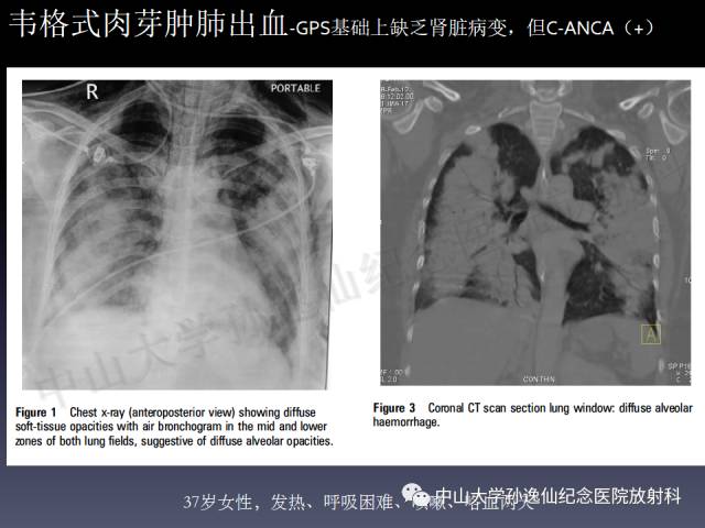 【PPT】肺出血的影像学特征