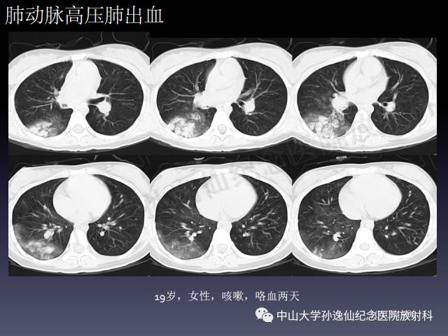 【PPT】肺出血的影像学特征