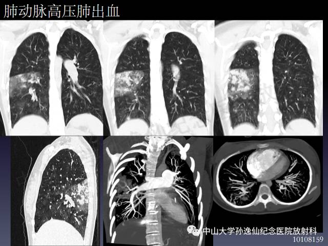 【PPT】肺出血的影像学特征