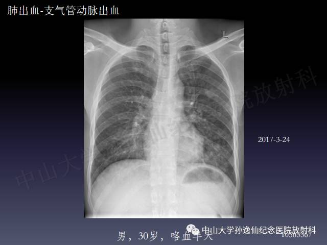 【PPT】肺出血的影像学特征