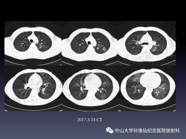 【PPT】肺出血的影像学特征