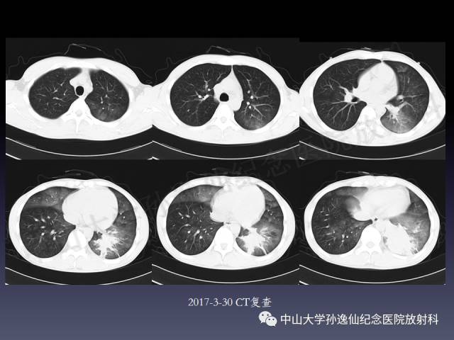 【PPT】肺出血的影像学特征