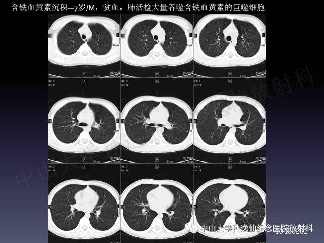【PPT】肺出血的影像学特征