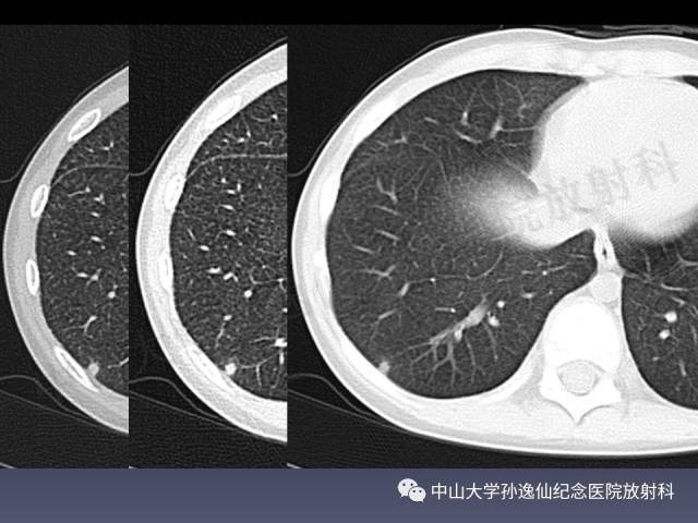 【PPT】肺出血的影像学特征