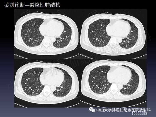 【PPT】肺出血的影像学特征
