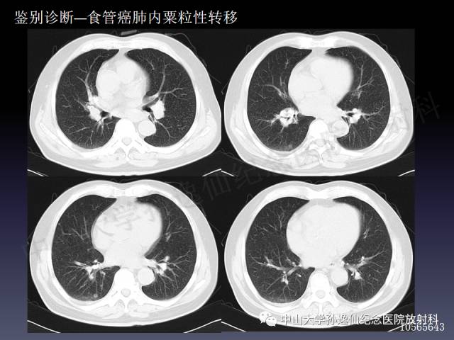 【PPT】肺出血的影像学特征