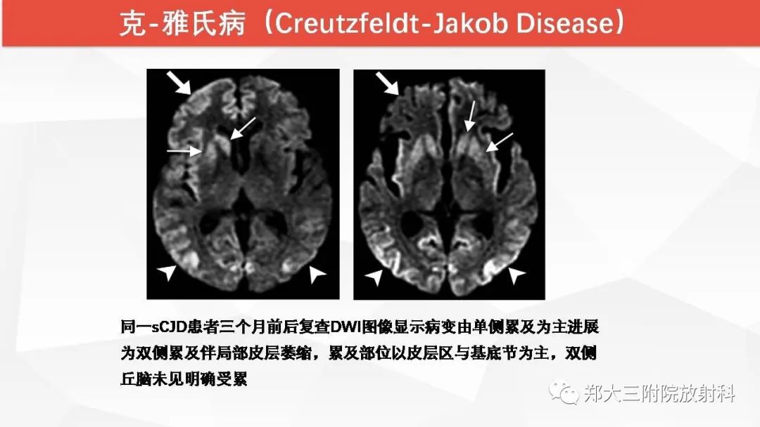 【PPT】Wernicke脑病的影像诊断