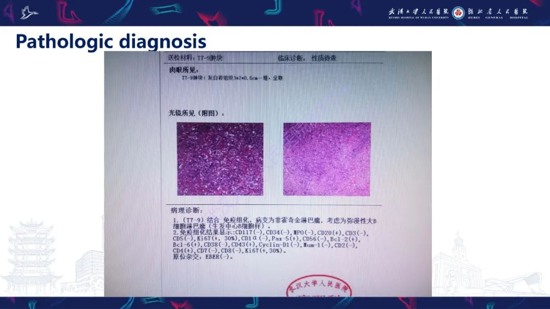 【PPT】原发性椎管内淋巴瘤影像诊断