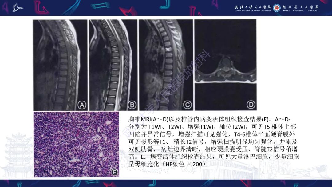 【PPT】原发性椎管内淋巴瘤影像诊断