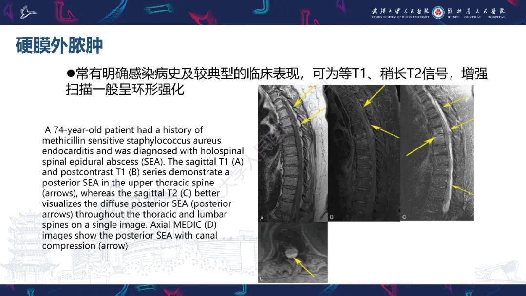 【PPT】原发性椎管内淋巴瘤影像诊断